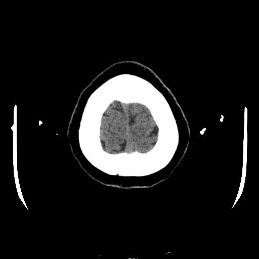 File:Cerebral venous thrombosis with venous hemorrhagic infarct (Radiopaedia 90354-107660 Axial non-contrast 48).jpg