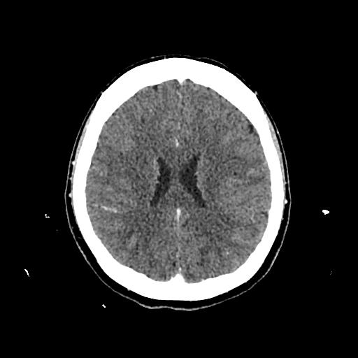 Cerebral venous thrombosis with venous hemorrhagic infarct (Radiopaedia 90354-107660 Axial with contrast 107).jpg