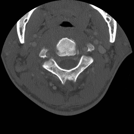 Cervical Pott disease (Radiopaedia 20374-20286 Axial bone window 43).jpg