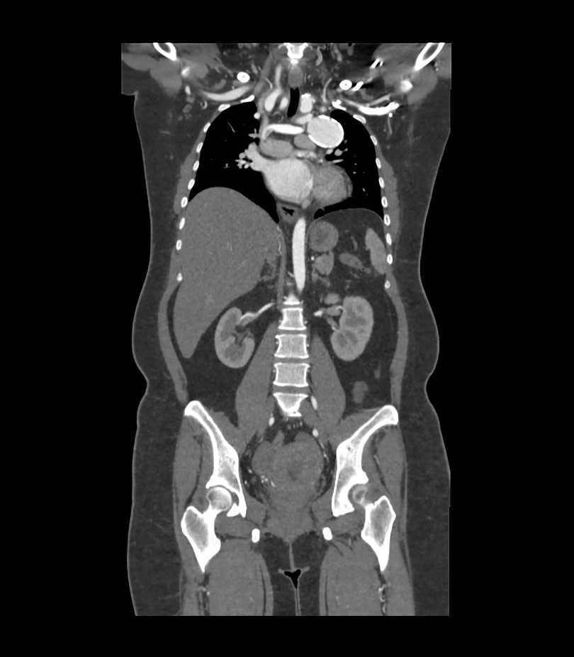 Cervical aortic arch with coarctation and aneurysms (Radiopaedia 44035-47552 C 22).jpg