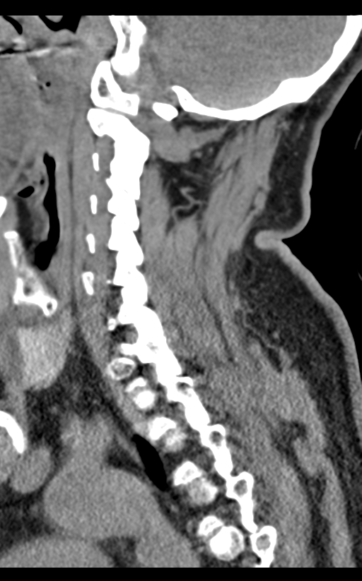 Cervical canal stenosis - OPLL and osteophytes (Radiopaedia 47329-51910 B 29).png
