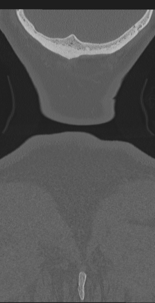 Cervical canal stenosis due to ossification of the posterior longitudinal ligament (Radiopaedia 47260-51823 Coronal bone window 78).png