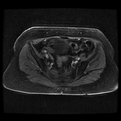 Cervical carcinoma (Radiopaedia 70924-81132 Axial T1 C+ fat sat 151).jpg