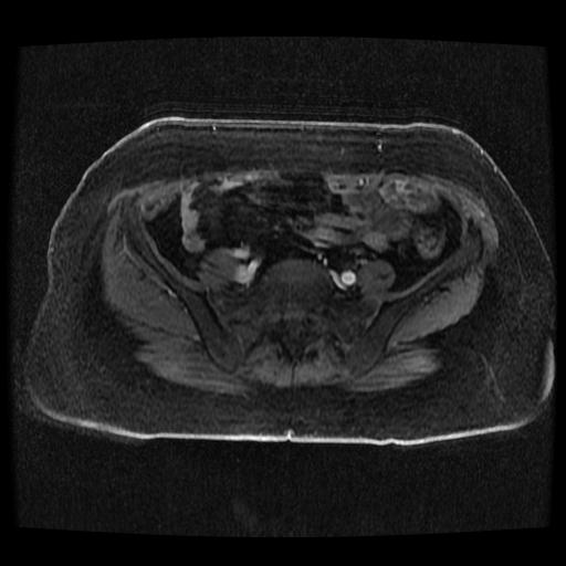 Cervical carcinoma (Radiopaedia 70924-81132 Axial T1 C+ fat sat 75).jpg
