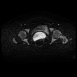 Cervical carcinoma (Radiopaedia 88010-104555 Axial DWI 47).jpg