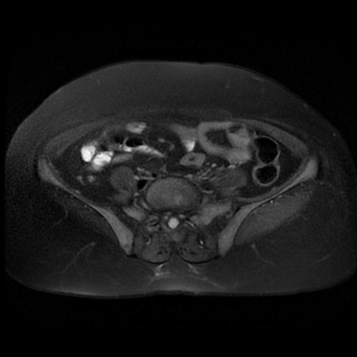 File:Cervical carcinoma (Radiopaedia 88010-104555 Axial T2 fat sat 2).jpg