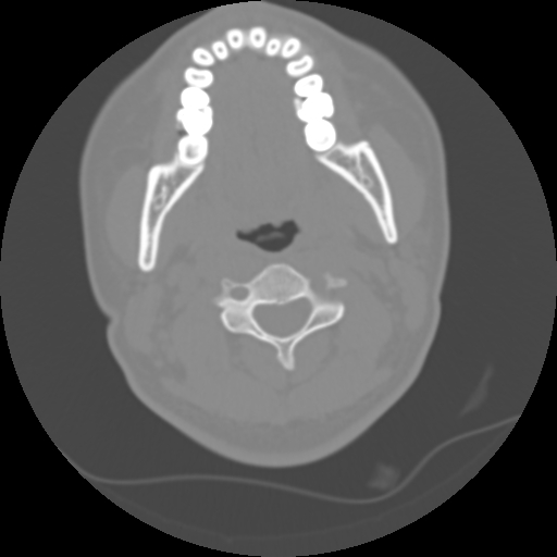Cervical rib (Radiopaedia 71110-81363 Axial non-contrast 26).jpg