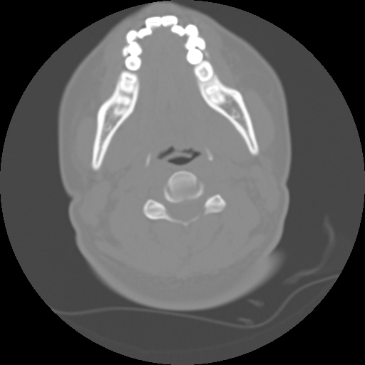Cervical rib (Radiopaedia 71110-81363 Axial non-contrast 28).jpg