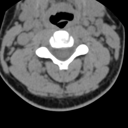 Cervical schwannoma (Radiopaedia 57979-64974 Axial non-contrast 28).png