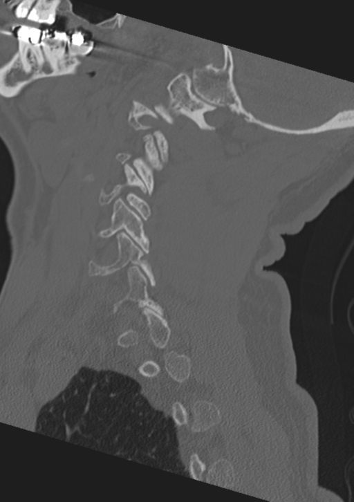 Cervical spine fractures with vertebral artery dissection (Radiopaedia 53296-59268 Sagittal bone window 51).png