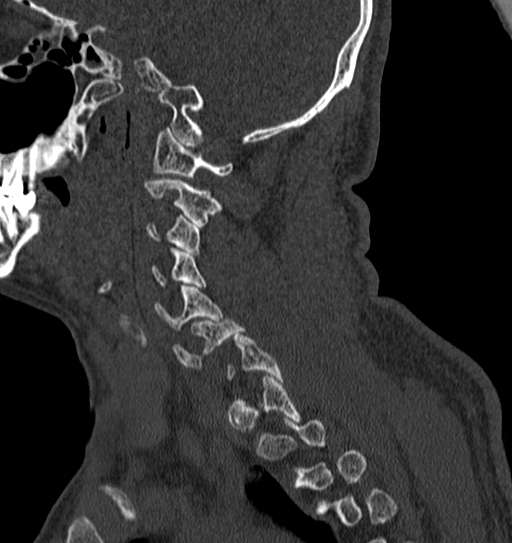 File:Cervical spine trauma with tear drop fracture and perched facet joint (Radiopaedia 53989-60127 Sagittal bone window 124).jpg