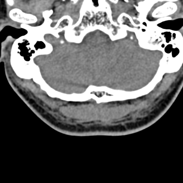 Cervical spondylodiscitis (Radiopaedia 28057-29489 Axial non-contrast 7).jpg