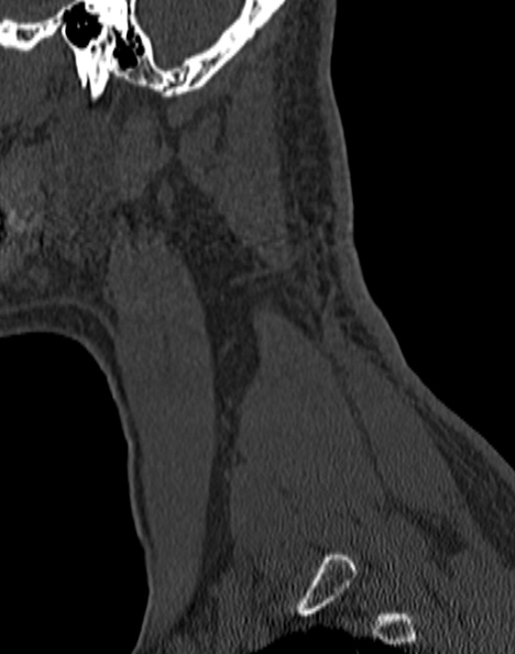 Cervical spondylodiscitis (Radiopaedia 28057-29489 Sagittal bone window 10).jpg