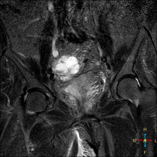 File:Cervical stump squamous cell carcinoma (Radiopaedia 48049-52858 G 4).jpg