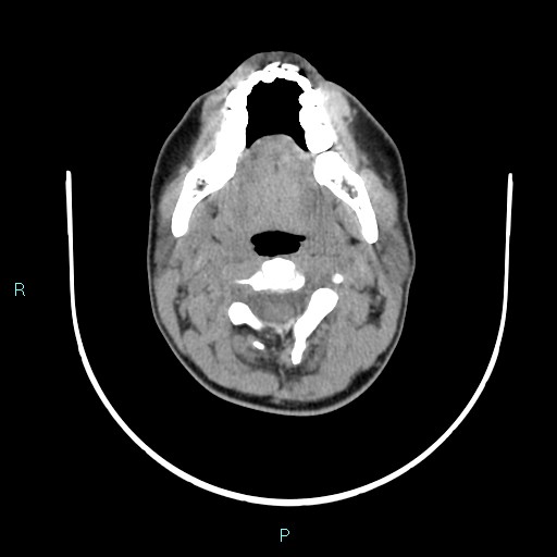 File:Cervical thymic cyst (Radiopaedia 88632-105335 Axial non-contrast 82).jpg