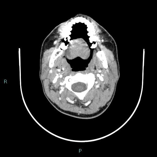 Cervical thymic cyst (Radiopaedia 88632-105335 B 86).jpg