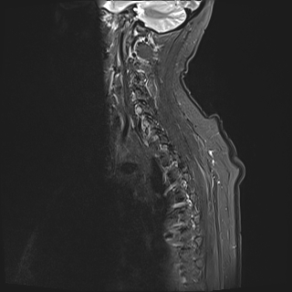 File:Cervical tumor-like myelopathy due to Type V dAVF (Radiopaedia 82461-96604 Sagittal STIR 3).jpg