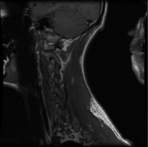 File:Cervical vertebrae metastasis (Radiopaedia 78814-91667 Sagittal T1 1).png