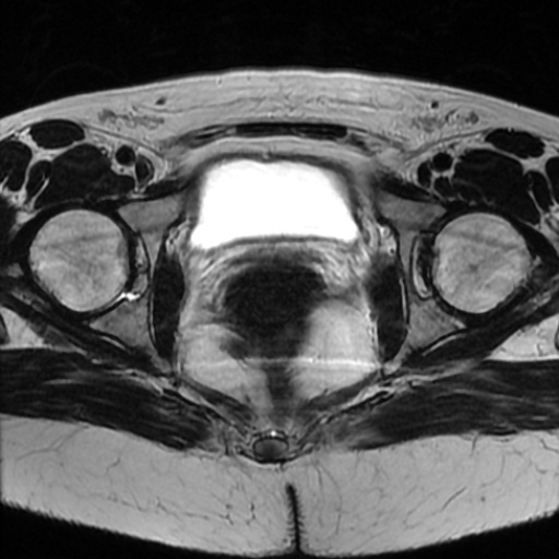 File:Cesarian section scar endometriosis (Radiopaedia 66520-75799 Axial T2 19).jpg