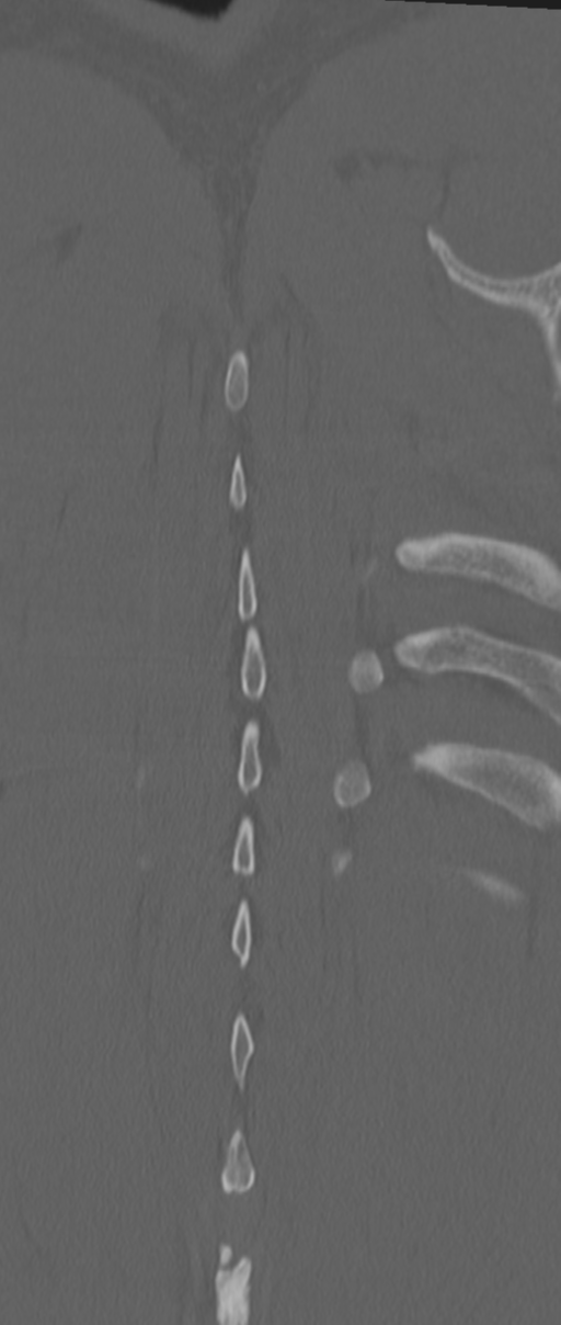 Chance fracture (Radiopaedia 33854-35020 Coronal bone window 78).png