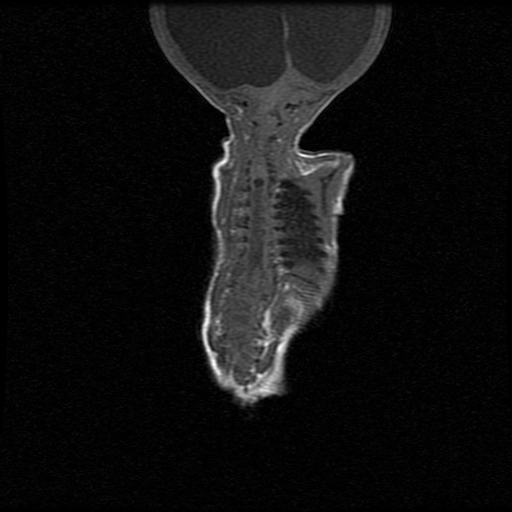 File:Chiari II malformation with spinal meningomyelocele (Radiopaedia 23550-23652 Coronal T1 7).jpg