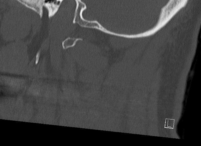 Chiari I malformation with a symptomatic syrinx of the posterolateral medulla oblongata (Radiopaedia 42573-45707 A 13).jpg