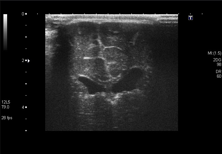 File:Chiari type II malformation - on ultrasound (Radiopaedia 24246).jpg