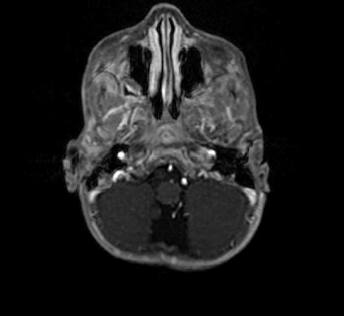 Chiasmatic-hypothalamic glioma (Radiopaedia 90079-107252 Axial T1 C+ 9).jpg