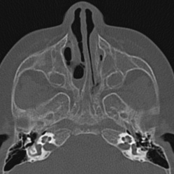 Choanal atresia (Radiopaedia 88525-105975 Axial bone window 34).jpg
