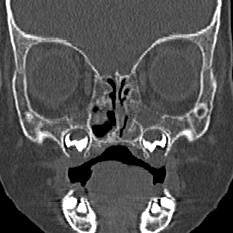 File:Choanal atresia (Radiopaedia 88525-105975 Coronal bone window 37).jpg