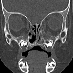 Choanal atresia (Radiopaedia 88525-105975 Coronal bone window 41).jpg