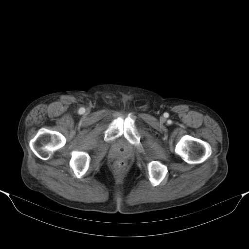 File:Cholangitis and abscess formation in a patient with cholangiocarcinoma (Radiopaedia 21194-21100 A 51).jpg