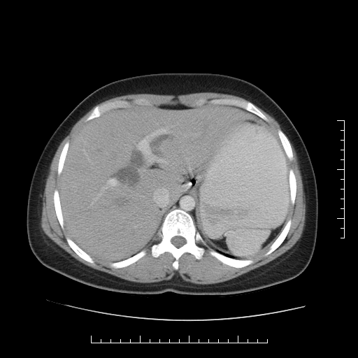 File:Choledochal cyst with chronic calcific pancreatitis (Radiopaedia 18245-18061 A 4).png