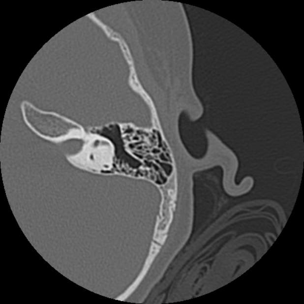 Cholesteatoma (Radiopaedia 73023-83750 Axial Left ear 52).jpg