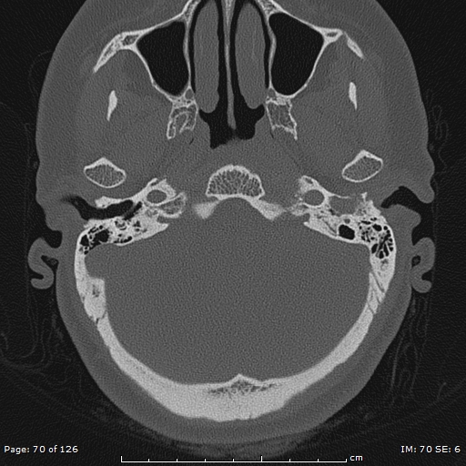 Cholesteatoma - external auditory canal (Radiopaedia 88452-105096 Axial bone window 33).jpg