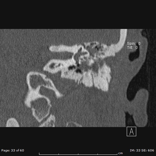 Cholesteatoma - external auditory canal (Radiopaedia 88452-105096 Coronal bone window 33).jpg
