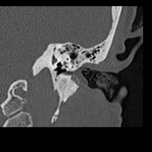 File:Cholesteatoma of the external ear (Radiopaedia 16540-16225 Coronal bone window 15).jpg