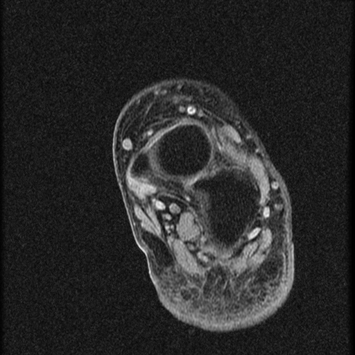File:Chondroblastoma - midfoot (Radiopaedia 64831-73765 F 7).jpg
