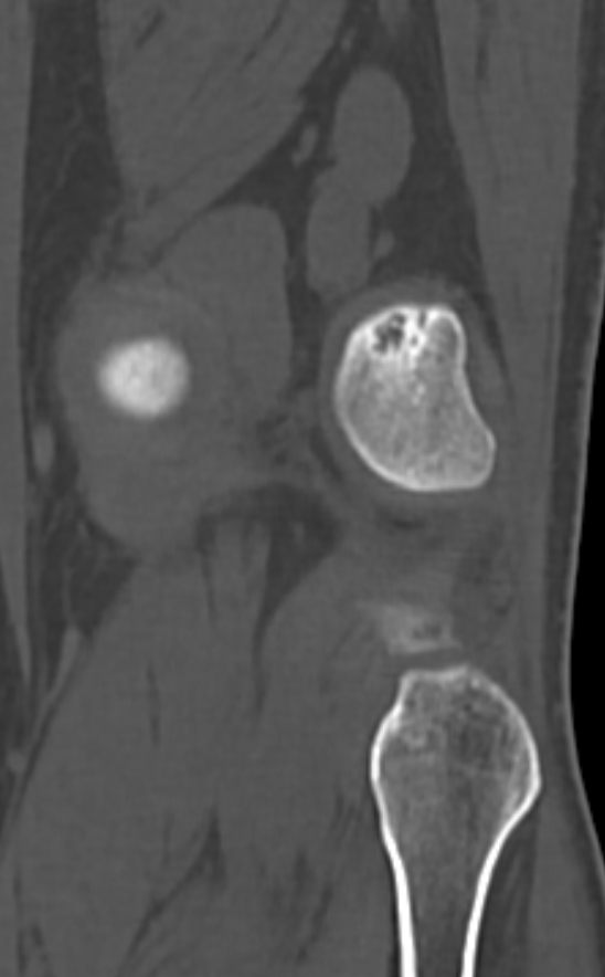 Chondrocalcinosis (Radiopaedia 82862-97173 Coronal bone window 65).jpg