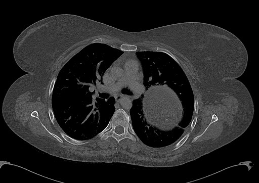 Chondrosarcoma - chest wall (Radiopaedia 65192-74199 Axial bone window 52).jpg