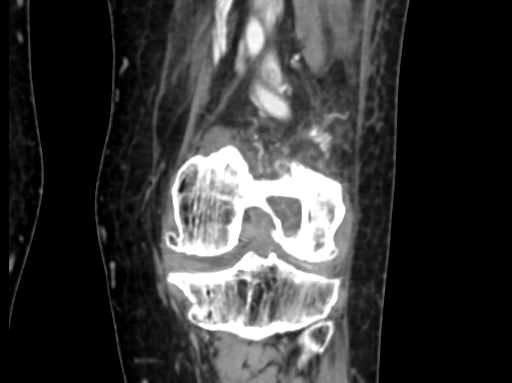 Chondrosarcoma - femur (Radiopaedia 64187-72954 C 37).jpg