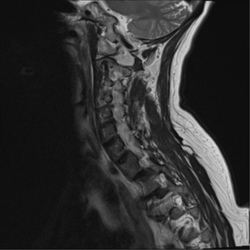 File:Chordoma (C4 vertebra) (Radiopaedia 47561-52189 Sagittal T2 3).png