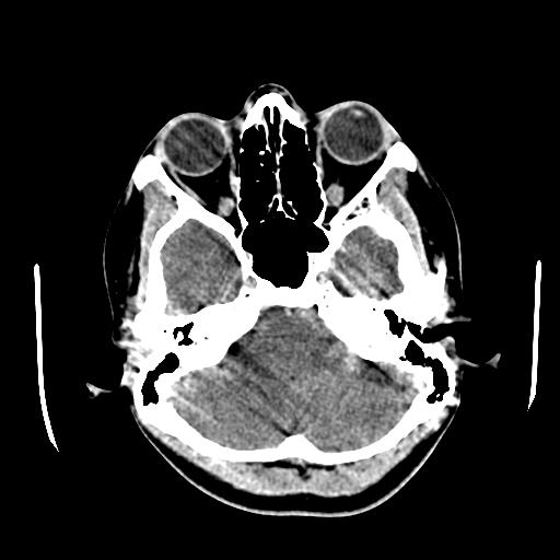 File:Choriocarcinoma of ovary with cerebral and pulmonary metastases (Radiopaedia 25983-26118 C+ arterial phase 26).jpg