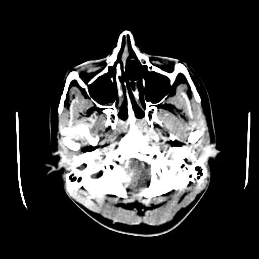 File:Choriocarcinoma of ovary with cerebral and pulmonary metastases (Radiopaedia 25983-26118 C+ arterial phase 5).jpg