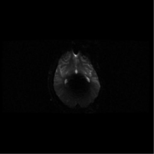 Choroid plexus papilloma (Radiopaedia 34951-36441 Axial DWI 40).png