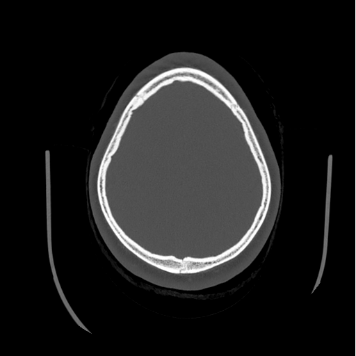 Choroid plexus papilloma extending into the cerebellopontine angle cistern (Radiopaedia 85941-101833 Axial bone window 76).png