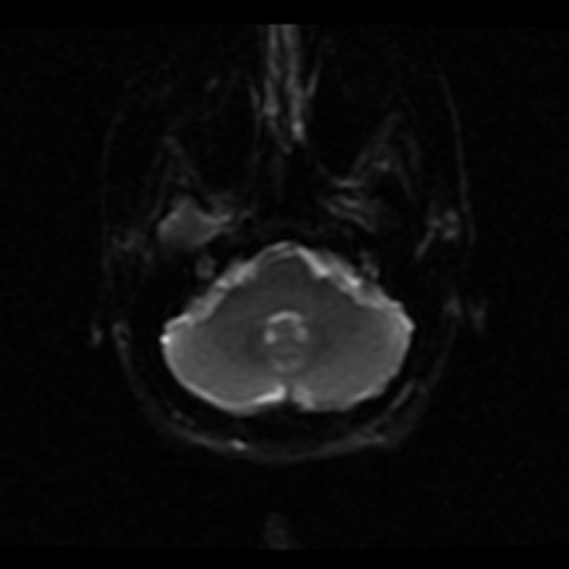 File:Choroid plexus xanthogranuloma (Radiopaedia 17650-17386 ADC 19).jpg