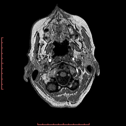 Choroid plexus xanthogranuloma (Radiopaedia 67843-77270 Axial T1 151).jpg