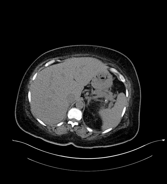 Chromophobe renal cell carcinoma (Radiopaedia 84239-99519 Axial non-contrast 45).jpg