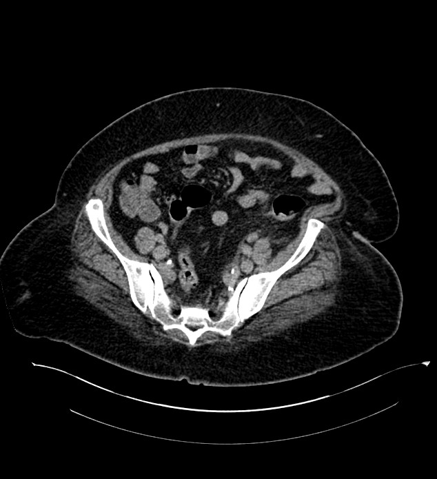 Chromophobe renal cell carcinoma (Radiopaedia 84239-99519 E 122).jpg